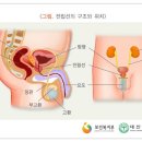 전립선비대증 이미지