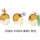 외상에 의한 뇌 손상Traumatic brain injury뇌신경정신질환, 응급질환 이미지