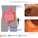 ﻿궤양성 대장염[Ulcerative colitis] ﻿ 이미지