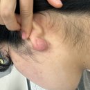 켈로이드 수술 3번째 후기ㅣ신사역 켈로이드 수술/전자선치료