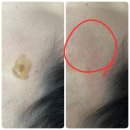 구은희피부 | 배곧피부관리 내돈내산 구은희에스테틱에서 기미지우개 대박이니까 후기 일단 보세요