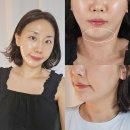 강남 청담 피부과 온다리프팅 7만줄 후기 가격, 통증 솔직 리뷰