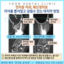 연지동치과 재신경치료잘하는 윤치과, 치아를 뽑지말고 살릴수 있는 마지막 방법