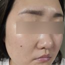 양산에스테틱 모공 탄력관리 콜드 플라즈마 양산 스킨스토리