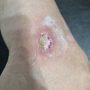 일부상신 | [2탄] 핫팩/ 저온 화상(심재성 2도 화상) 치료기 - 가피절제술, 피판술 후기