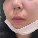 펄스메디칼 | (4) 입술,인중 개물림 흉터치료 내돈내산 여정 (울산/부산)