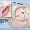 Intracranial hematoma 이미지