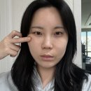 100-1-000023 | 인천구월동피부과 땅콩형얼굴 튠라이너 인모드 스킨보톡스 후기 내돈내산