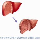 술 좋아하고 뚱뚱하면 '간'은 이 모양 이 꼴! 이미지