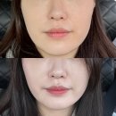 김해웨딩관리 수에스테틱 리프팅 후기, 피부탄력 윤곽라인 리얼 변화