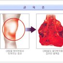 골육종암 뼈암 원인 이미지