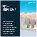 노인임플란트 충분히가능해요 이미지