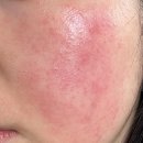 대지화장품 | 홍조 피부 화장품 추천 의사 크림으로 바꾸고 얼굴 붉어짐 극복