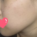 일산메이퓨어의원 | 된다는 건 내 돈 내고 내 살 타는 냄새를 맡는다는 뜻일까?/메이퓨어의원 일산점에서 주근깨 점 제거