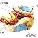 머릿속의 시한폭탄“뇌동맥류 이미지