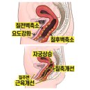 신암카톨릭비뇨기과의원 | 요실금치료병원, 재발되지 않으려면 봐야 할 3가지?