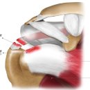 오십견과 회전근개 파열의 차이점 이미지