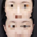 은도빌딩 | 귀필러 후기 / 귀필러 붓기 / 귀필러 뒤 / 강남역피부과 추천