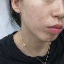 이원행 화접몽한의원 | 파주 피부과 여드름치료 추천 - 화안치료 후기