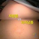성누가외과의원 | 지방종이란? 피지낭종과 차이점 한번에 정리 | 중랑구 망우동 성누가외과의원