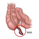 맹장염(Appendicitis) 소화기질환, 응급질환이란? 이미지