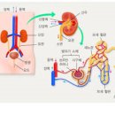 신장결석 원인과 증상 예방 방법 이미지