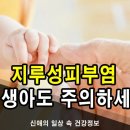 신생아 지루성피부염 원인과 치료에 대해 알아보자 이미지