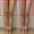 H-5 | 인천다이어트병원 h클리닉 허벅지 지방분해주사 5회차 후기 확실한 변화 뷰티데이 태세리뷰