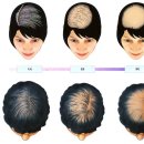 김원장면역테라피 | 여성탈모 치료 - 머리가 얇아지고 숱이 적어진 것 같다면..