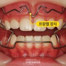 미바른이치과교정과치과의원 | 동성로교정치과 어린이 치아교정 프랑켈