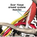 흉곽출구 증후군(thoracic outlet syndrome) 이미지