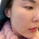 하이엔드멍 | 내돈내산 대치동피부과 옆볼필러 1cc붓기, 부작용,멍,후기