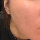 대화한의원 | [beauty]수부지 문제성 피부관리_대구 메디컬오 한의원 3회차 후기(시술 후 재생크림 추천)