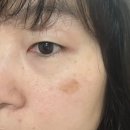 새마음의원 | 광화문흑자제거 테라스의원 리팟레이저 후기｜눈밑 흑자 제거 드디어 결심