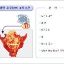 스크랩] 후두암┃후두암의 증상 이미지