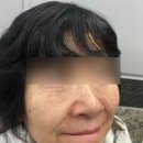 영마루공원관리실화장실 | 압구정로데오역 도산공원 한의원에서 받은 스킨부스터 듀얼젠 후기