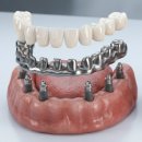 ALL(올)바른 PC | 대구 임플란트 틀니 , 올온엑스와 차이점은