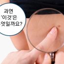 쥐젖 제거 방법 이미지