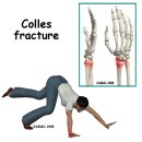 콜레스 골절[Colles fracture] / 스미스 골절[smith fracture] 이미지