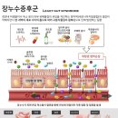 장누수 증후군 이미지