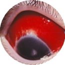출혈성 결막염[Hemorrhagic conjunctivitis]눈질환 이미지