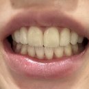 스카이치과기공소 | 라미네이트 (오픈바이트 환자) 생생 리얼 후기