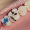 🦷마산아미치과의원 후기