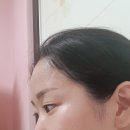 리앤영의원 | [포토리뷰] 홍대 리앤영 눈밑꺼짐필러 후기
