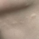 더스케치성형외과의원 | [내돈내산][논현 더뷰티 성형외과 후기] 울쎄라300샷+눈가보톡스 72만원