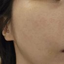 브이 | 압구정 피부과레이저 홍조 잡티제거 엑셀브이 재방문 후기