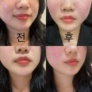 블랑쥬의원 | 대구 쥬베룩볼륨 후기 -대구 쥬베룩 잘하는 곳/대구 피부과/대구 쥬베룩 후기/쥬베룩 볼륨 후기