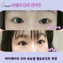 에이치프라자 | 바이에이치 구리 LED 펌포인트&amp;속눈썹연장 솔직후기
