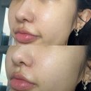 향동디자인 - 1116 | 향동피부과 팔자필러 후기 리쥬비엘 2cc 전후사진