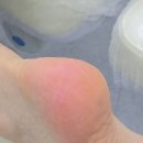 대흥역 발각질 제거 하이푸스 마포대흥점 신생아 발된 후기